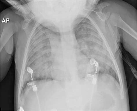 Chest X Ray At Hospitalization A Few Hours After The Injury In Which