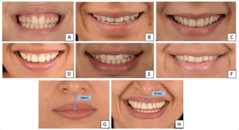 Gingival And Interdental Smile Lines And Upper Lip Length A High