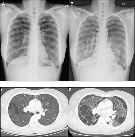 Benign Metastasising Leiomyomatosis Of The Lung Presenting As
