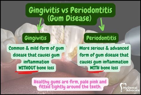 Gingivitis Vs Periodontitis Periodontal Disease