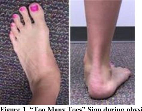 Figure From Adult Acquired Flatfoot Deformity A Review And Gait Analysis Of Posterior Tibial