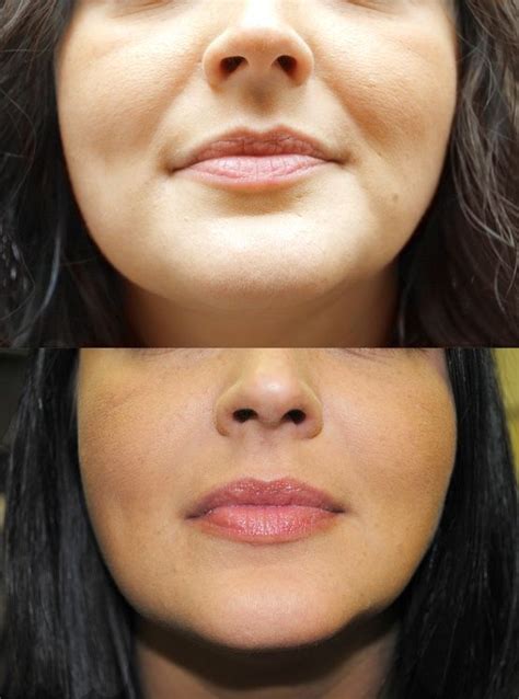 Juvederm Before And After Picture For The Nasolabial Fold Area About
