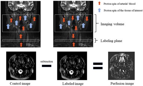 Cancers Free Full Text Pseudocontinuous Arterial Spin Labeling