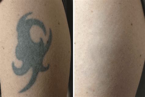 Tattoo Removal With The Picosure® Laser The Spa At Spring Ridge