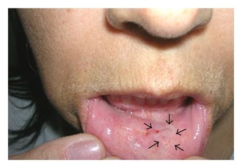 Clinical Signs Of The Lesions A White Macule On The Lower Lip