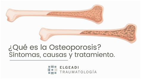 Qué es la osteoporosis síntomas causas y tratamiento YouTube