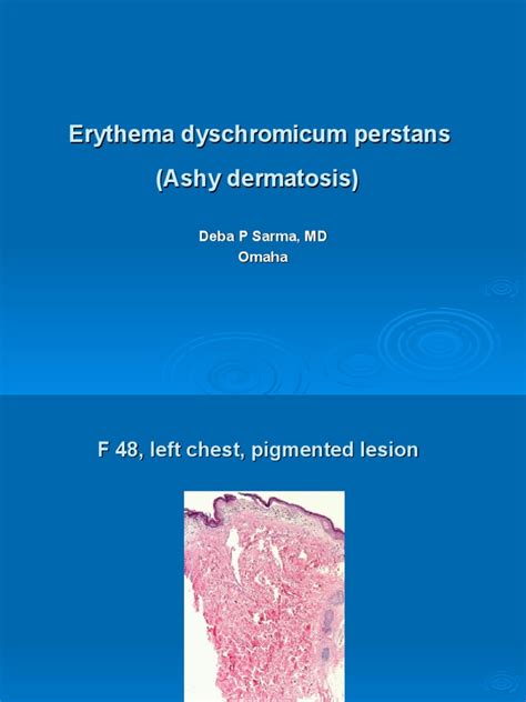 Erythema Dyschromicum Perstans F 48 Left Chest Pigmented Lesion Pdf