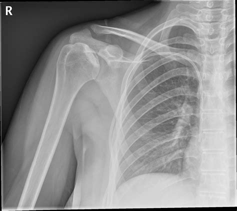 Avascular Necrosis Humerus