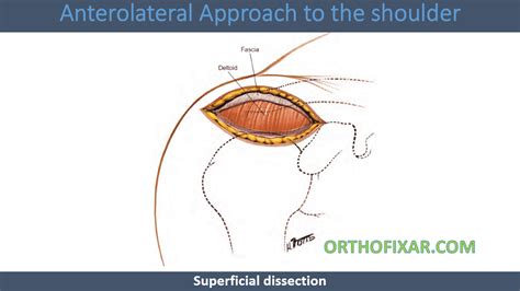 Anterolateral Approach To The Shoulder 2023 Orthofixar
