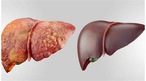 We did not find results for: Why is it Important to Keep our Liver in Good Shape ...