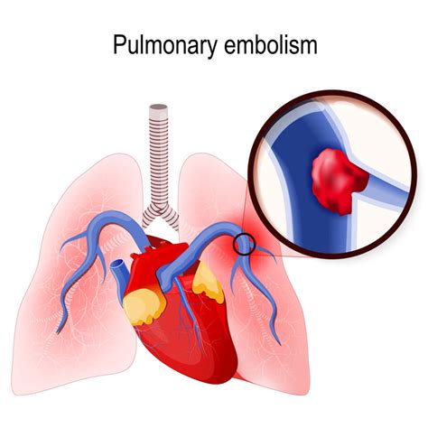 Pulmonary Embolism Lg Chestmed