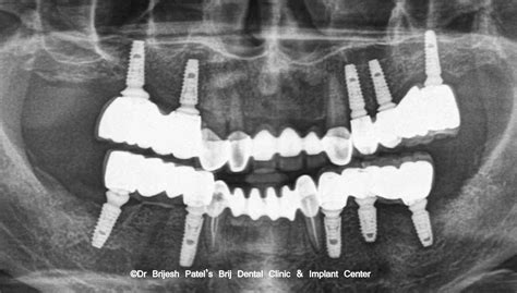 Opg Showing Implant Cases Brij Dental Clinic