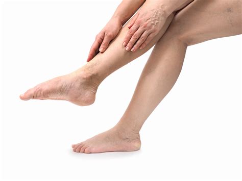 Recognizing And Healing Venous Stasis Ulcers Vegas Valley Vein