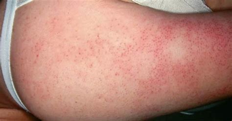 What Red Bumps On Your Upper Arms Really Mean Homefitnessgarage