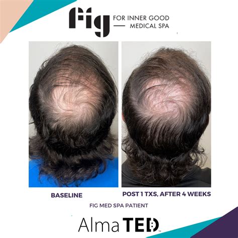 Ted Hair Restoration Fig Medical Spa