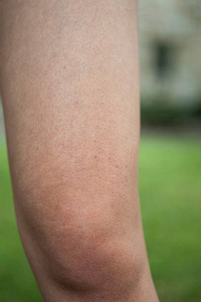 Keratosis Pilaris Stock Photos Pictures And Royalty Free Images Istock