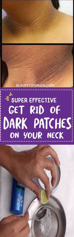 How To Get Rid Of Dark Patches Dark Patches On Skin Dark Patches On