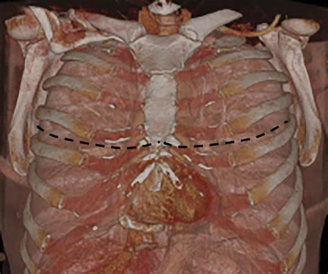 Imaging Course Of Lung Transplantation From Patient Selection To