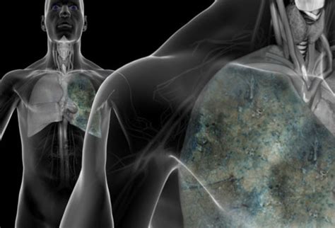 Other tumors (e.g., malignant melanoma) most often spread to the lungs, which act as a filter for tiny cancer cells. Lung Cancer Pictures: X-Rays of Tumors, Screening ...
