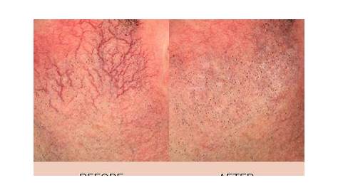 Vascular lesions (Facial and Body) - Aesthetic & Plastic Surgery Center