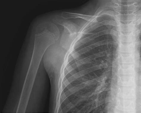 Anteroposterior Ap X Ray Of The Right Shoulder At Initial