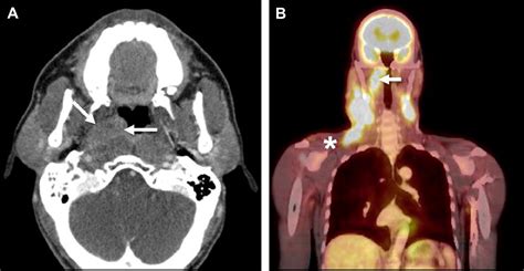 Pitfalls In The Staging Of Cancer Of Nasopharyngeal Carcinoma