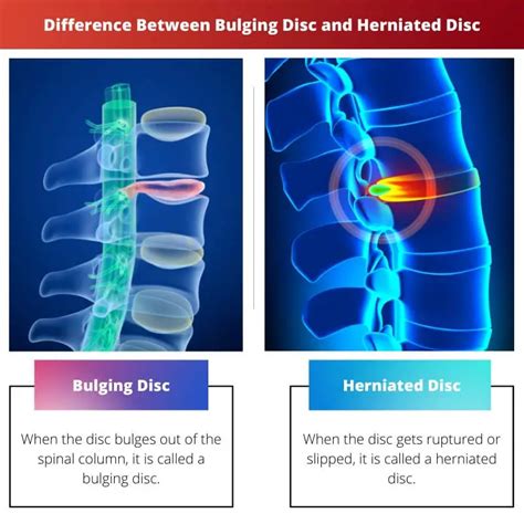 Bulging Disc Vs Herniated Disc Difference And Comparison