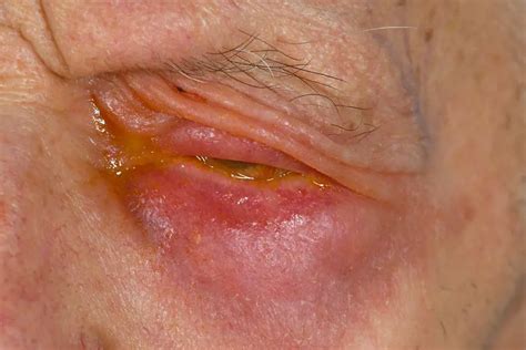 Identifying And Treating Seborrheic Dermatitis On The Eyelid