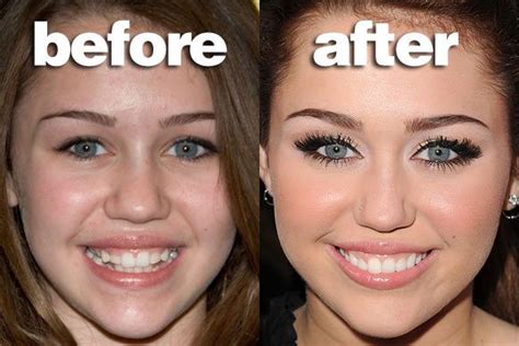 Miley S Teeth Before After Implants Dentaires Implant Dentistry