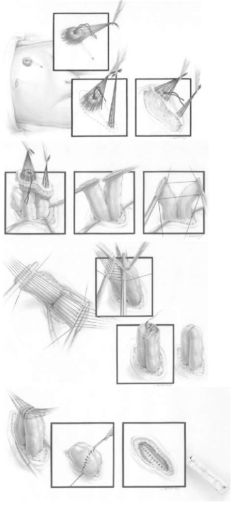 Artistic Diagram Of The Colostomy Closure Technique Download
