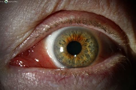 Conjunctival Lymphoma Online Atlas Of Ophthalmology The University Of