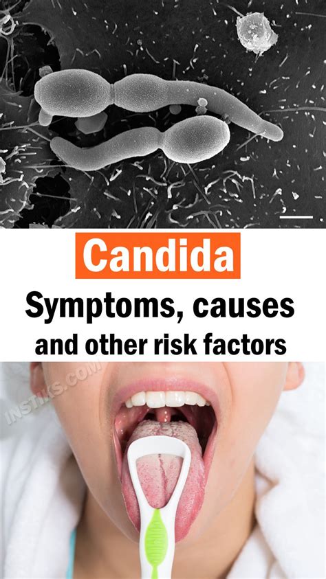 Candida Symptoms Causes And Other Risk Factors Candida Symptoms