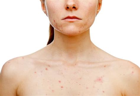 How To Get Rid Of Chest Acne Us Dermatology Partners