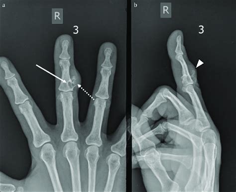Case 2 Conventional Radiographs Of The Right Third Finger Ap A And