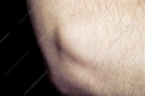 Tennis elbow swelling - Stock Image - C011/7430 - Science Photo Library