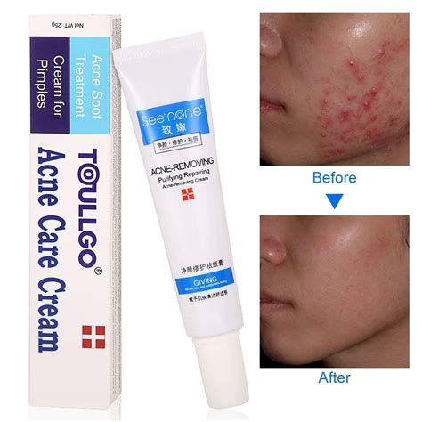 Buy Cystic Acne Treatment Acne Treatment Cream Acne Cream Acne Acne Patch Topical Anti