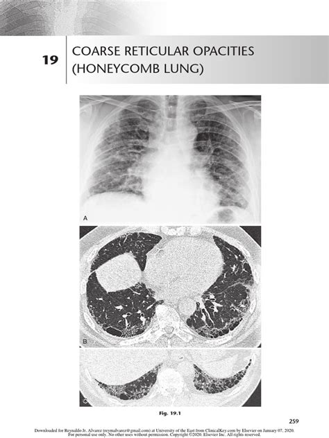 Chest Radio 19 Coarse Reticular Opacities Pdf Lung Pulmonology