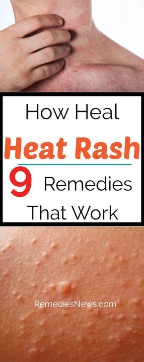 How To Get Rid Of Heat Rash Quickly 9 Remedies To Heal Heat Rash That