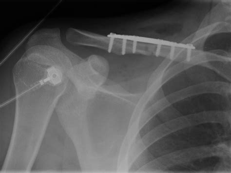 Clavicle Plating System Acumed