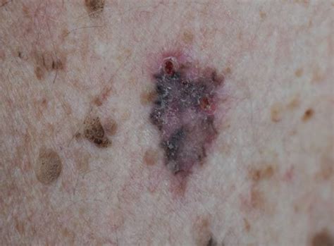 Benign Skin Lesions On Scalp