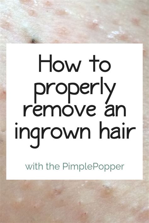 How To Remove An Ingrown Hair Ingrown Hair Solutions August 2021