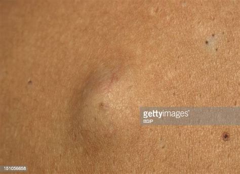 Sebaceous Cyst Of The Shoulder Foto Di Attualità Getty Images