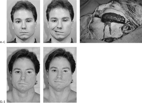 Free Muscle Transfers For Facial Paralysis Plastic Surgery Key