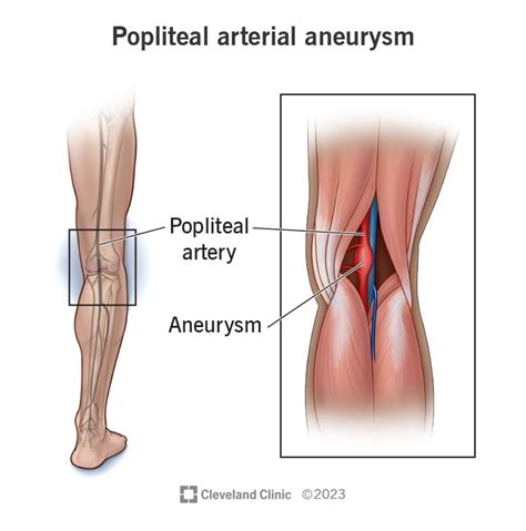 Popliteal Aneurysm Symptoms Treatment