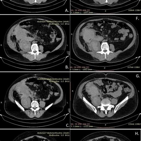 Iliopsoas Hematoma Control Ct 1 Year Download Scientific Diagram