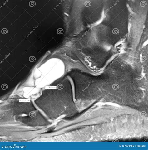 Plantar Foot Muscles Mri Muscles Of The Foot Dorsal Plantar The Best Porn Website
