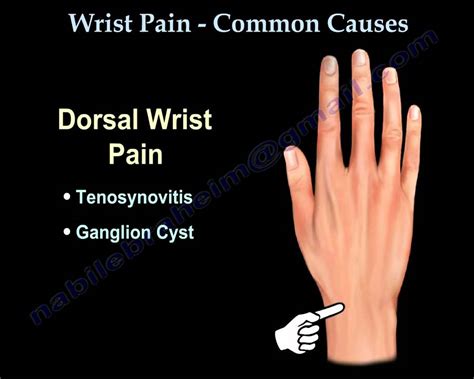 Wrist Pain Common Causes Everything You Need To Know Dr Nabil