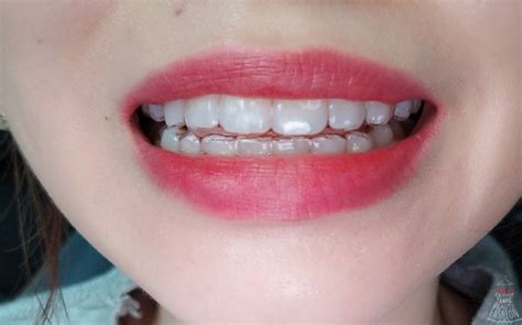 What Invisalign Looks Like And If Its Right For You Dental Health