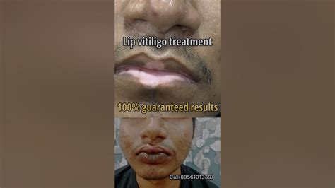 Lip Vitiligo Treatment 100 Guaranteed Results Lip Blushing For