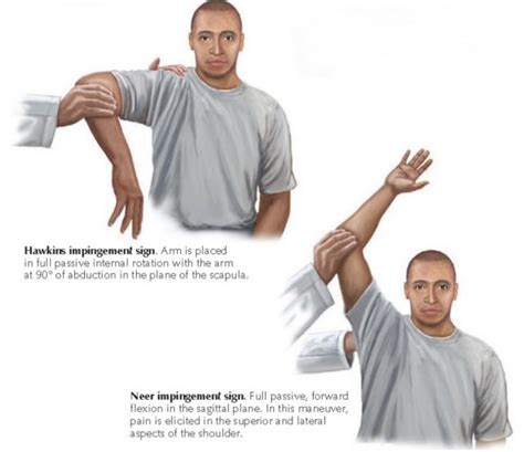 Rotator Cuff Tear Signs And Symptoms Diagnosis And Treatment Options